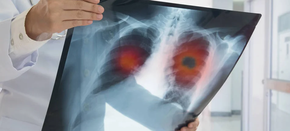 Pacjenci z rakiem płuca z dramatycznym apelem do Ministerstwa Zdrowia - Obrazek nagłówka