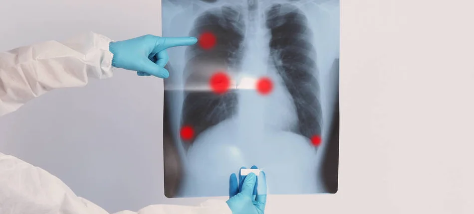 Będzie pilotaż leczenia gruźlicy wielolekoopornej w warunkach ambulatoryjnych - Obrazek nagłówka