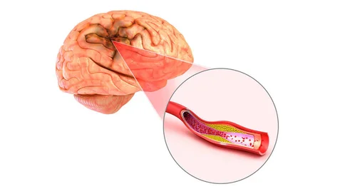 mozg-trombektomia
