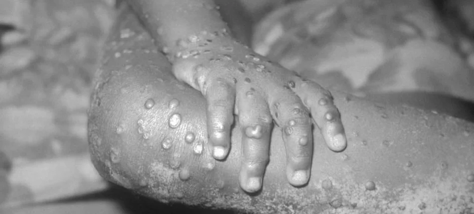 Monkey pox: Ministry of Health introduces new responsibilities - Header image