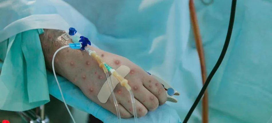 Monkey pox: over 6,000 cases worldwide. Is this already a pandemic? - Header image