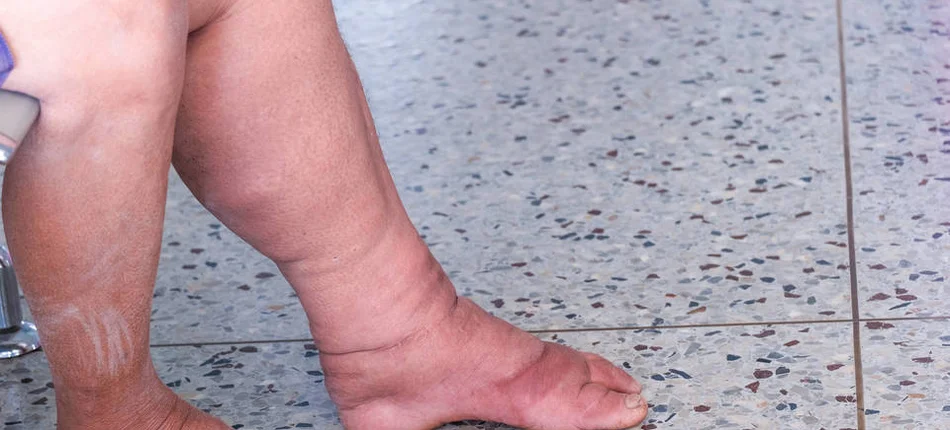 Lymphoedema cannot be taken lightly. Improperly treated, they lead to disability - Header image